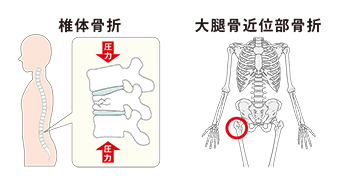椎体骨折・大腿骨近位部骨折